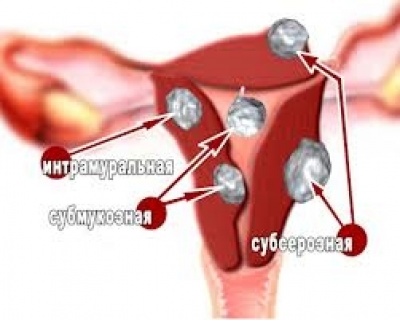 Uterine cancer