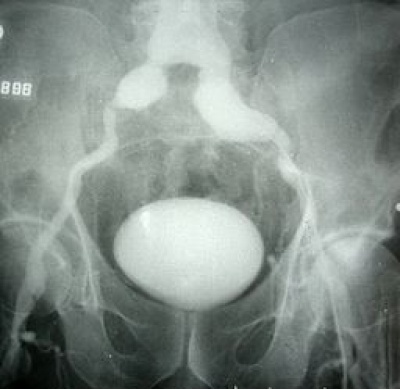 Peripheral Aneurysms