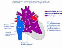 Tricuspid Valve Disease