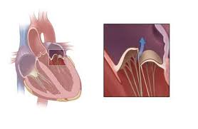 Mitral regurgitation