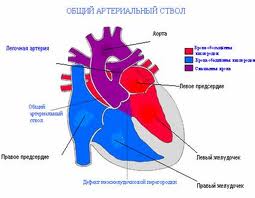 Persistent truncus arteriosus