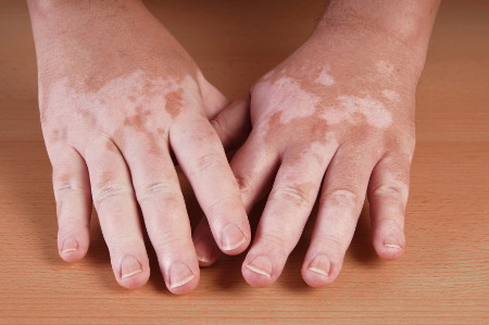 Vitiligo